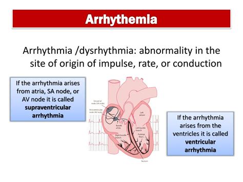 arrhythmia definition medical